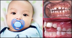 مکیدن انگشت در کودکان