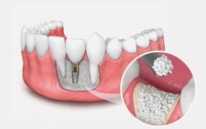 پیوند استخوان در لثه