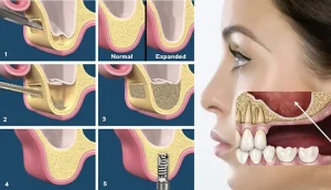 پیوند سینوس